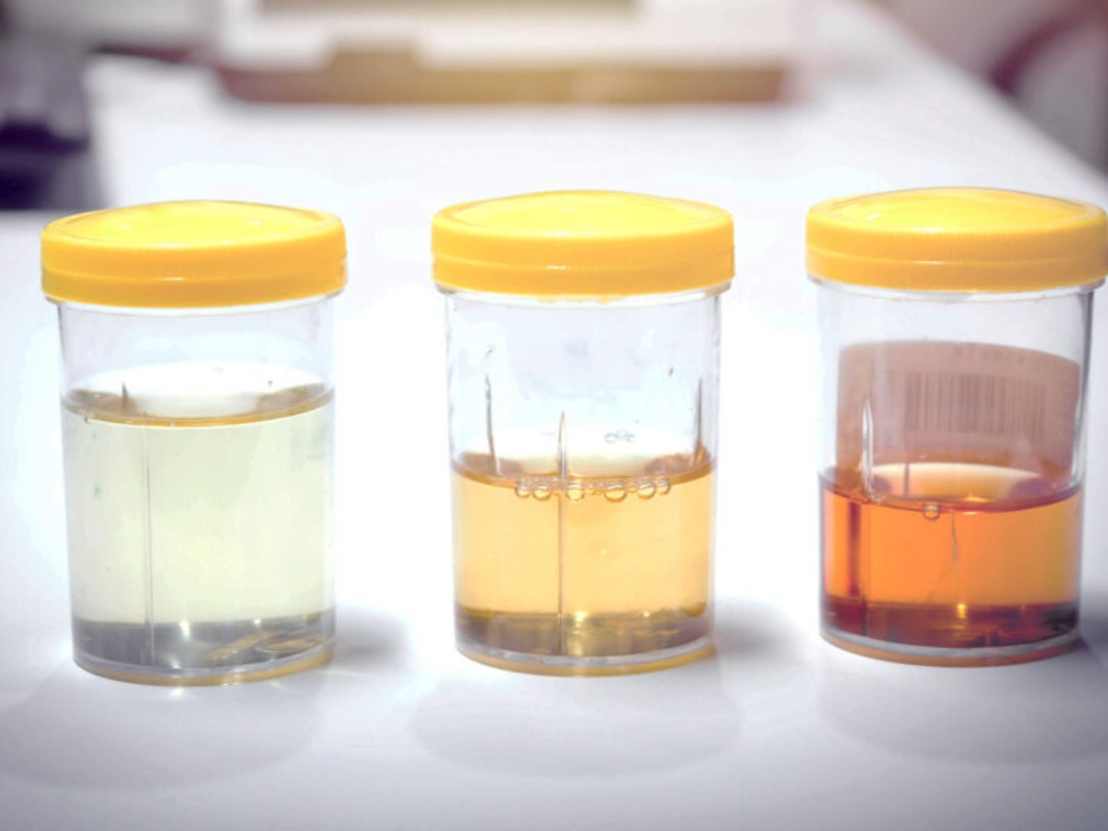 Urine Colour Guide: The Simplest Way to Know If You're Dehydrated